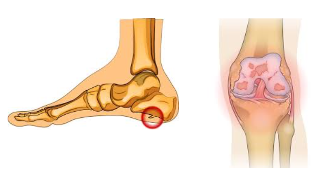 bone spur